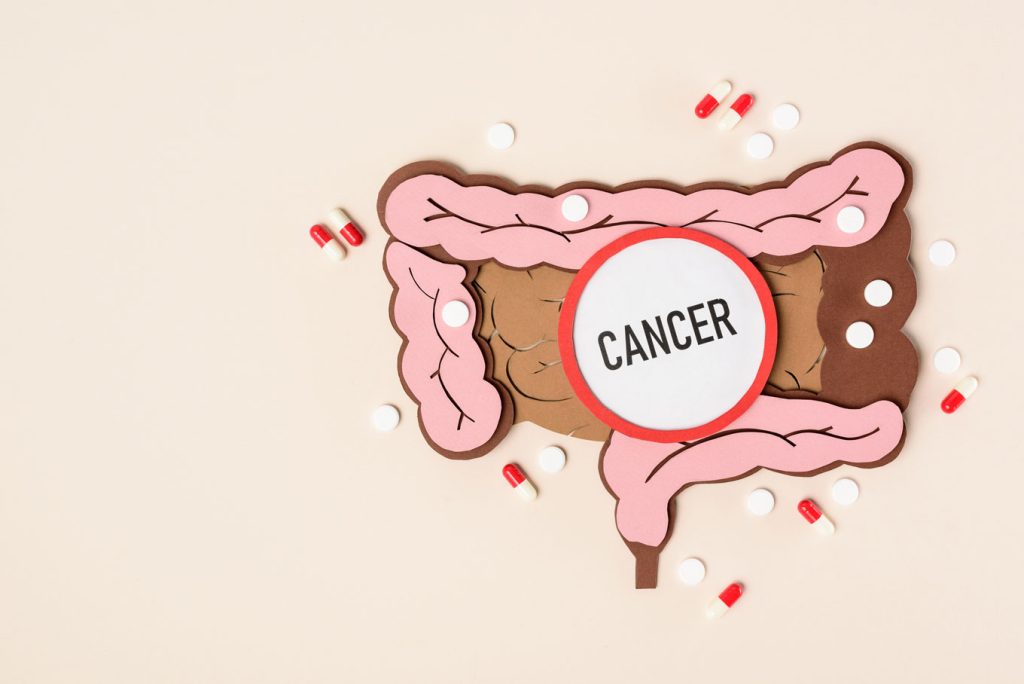 drawing of an intestine with the word cancer on it